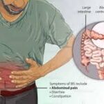 इरिटेबल बाउल सिंड्रोम क्यों होता है, जानिए आईबीएस के मुख्य लक्षण