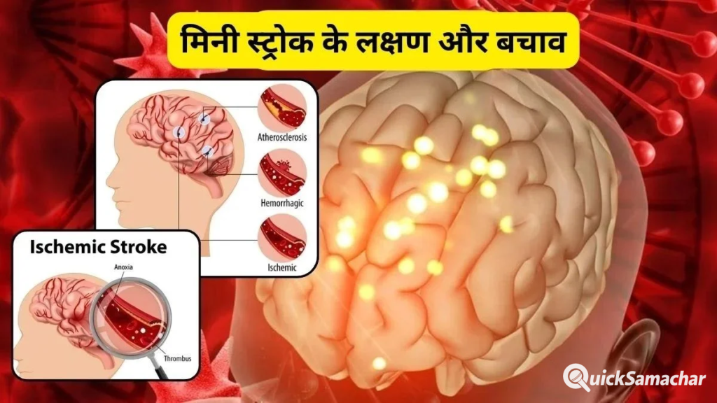मिनी स्ट्रोक क्या है? युवाओं में क्यों बढ़ रहा है खतरा, जानिए शुरुआती लक्षण, कारण और बचाव.. मिनी स्ट्रोक क्या है? युवाओं में क्यों बढ़ रहा है खतरा, जानिए शुरुआती लक्षण, कारण और बचाव..