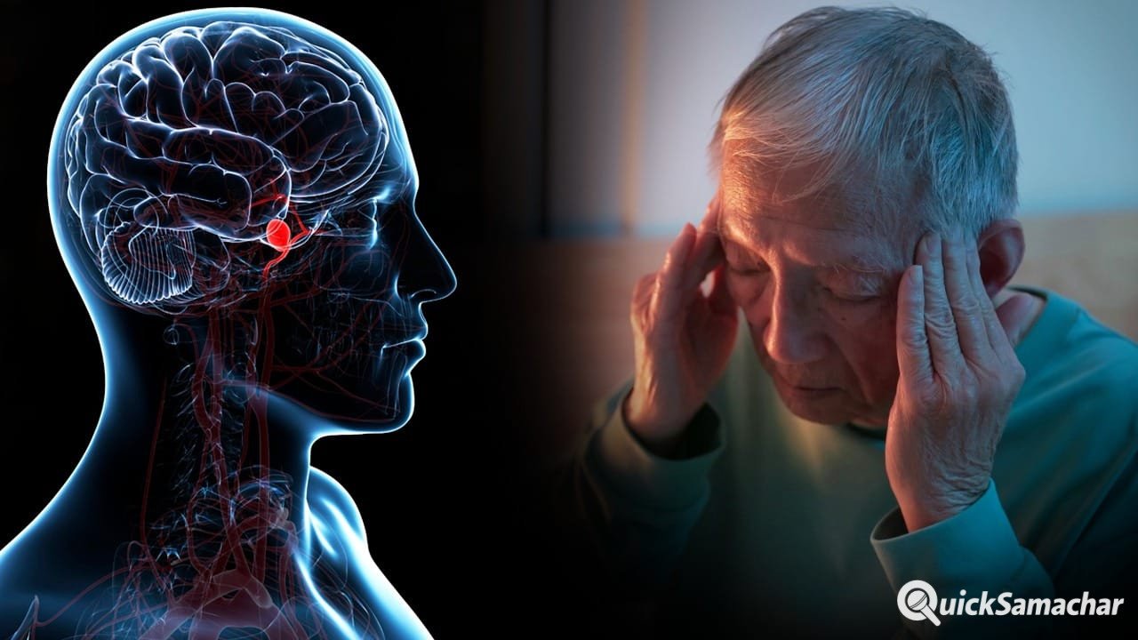 ब्रेन एन्यूरिज्म…दिमाग की नसों का गुबारे की तरह फूल जाना, ये क्यों होता है ब्रेन एन्यूरिज्म…दिमाग की नसों का गुबारे की तरह फूल जाना, ये क्यों होता है