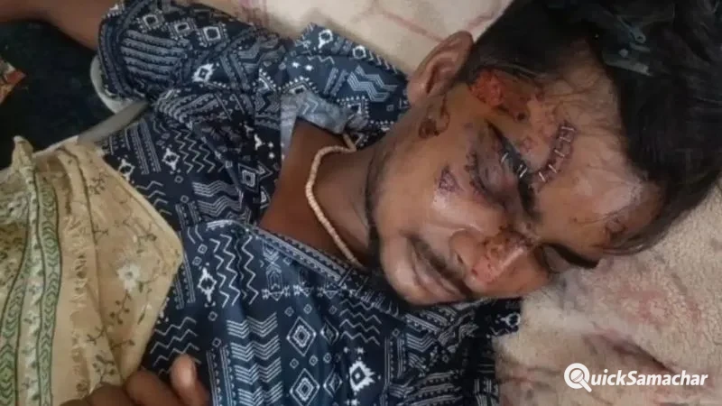 जेब में रखा Motorola फोन अचानक फटा, बुरी तरह झुलसा युवक, डॉक्टर ने टांकों की जगह लगा दिए स्टेपलर पिन