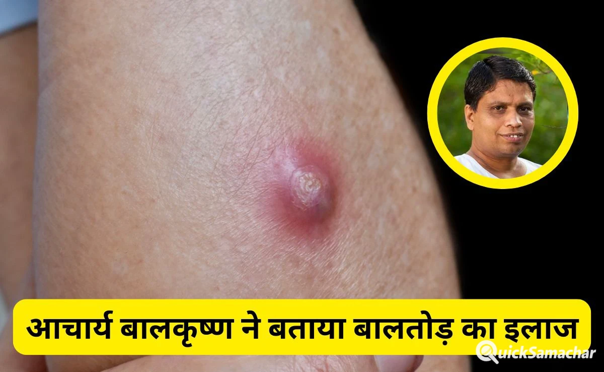 बालतोड़ का इलाज जल्दी कैसे करें? Acharya Balkrishna ने बताया कैसे ठीक होंगे ये फोड़े