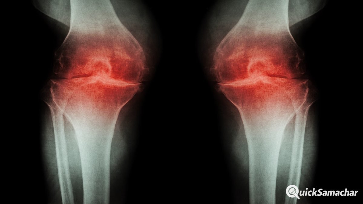 knee-osteoarthritis