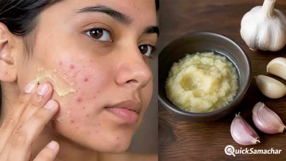 lahsun pimple